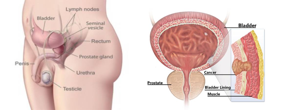 What is Bladder Cancer? Symptoms, causes, treatment