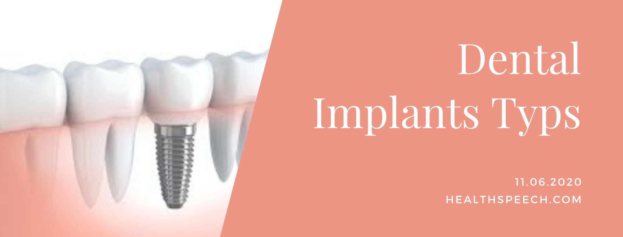 Types of dental implants, techniques & risks