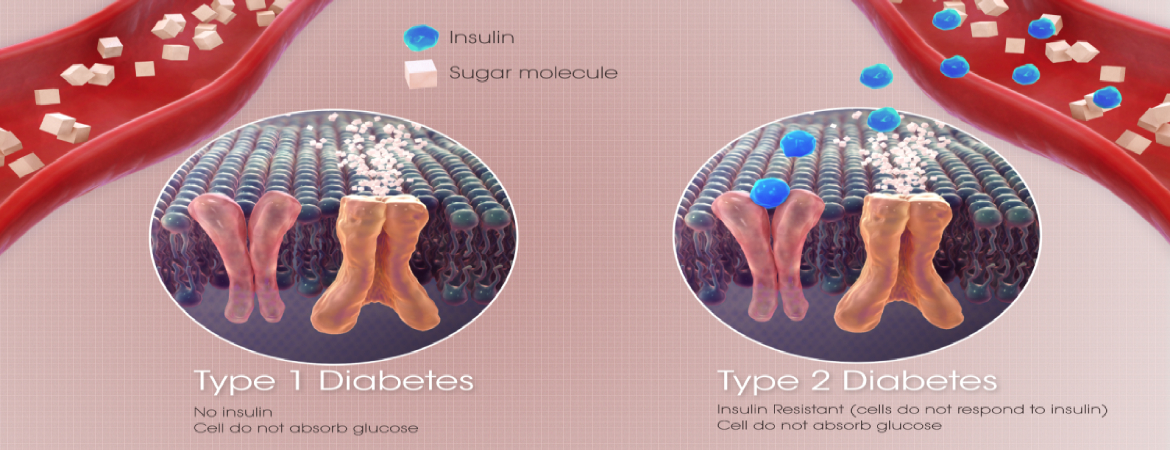 What Is Diabetes? Type 1 & 2 Diabetes, Symptoms, Causes