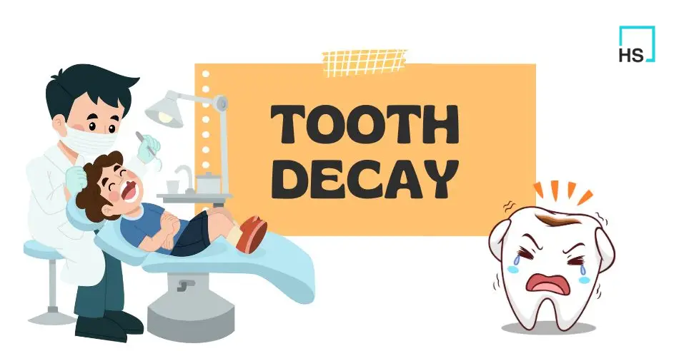 What Causes Tooth Decay - Symptoms, Treatment and Prevention